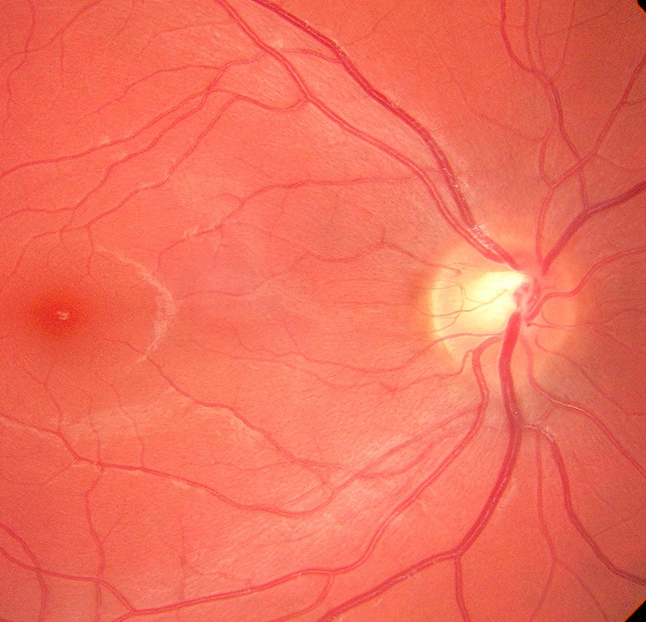 A medical image of the human retina, showing the optic disc and a network of blood vessels.