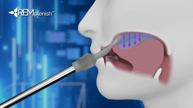 Illustration of a device inserted into a mouth with arrows indicating airflow.