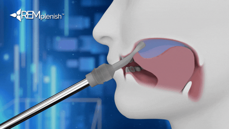 Illustration of a device inserted into a mouth with a blue background.
