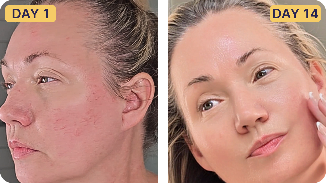 Side-by-side images of a woman's face labeled Day 1 and Day 14.