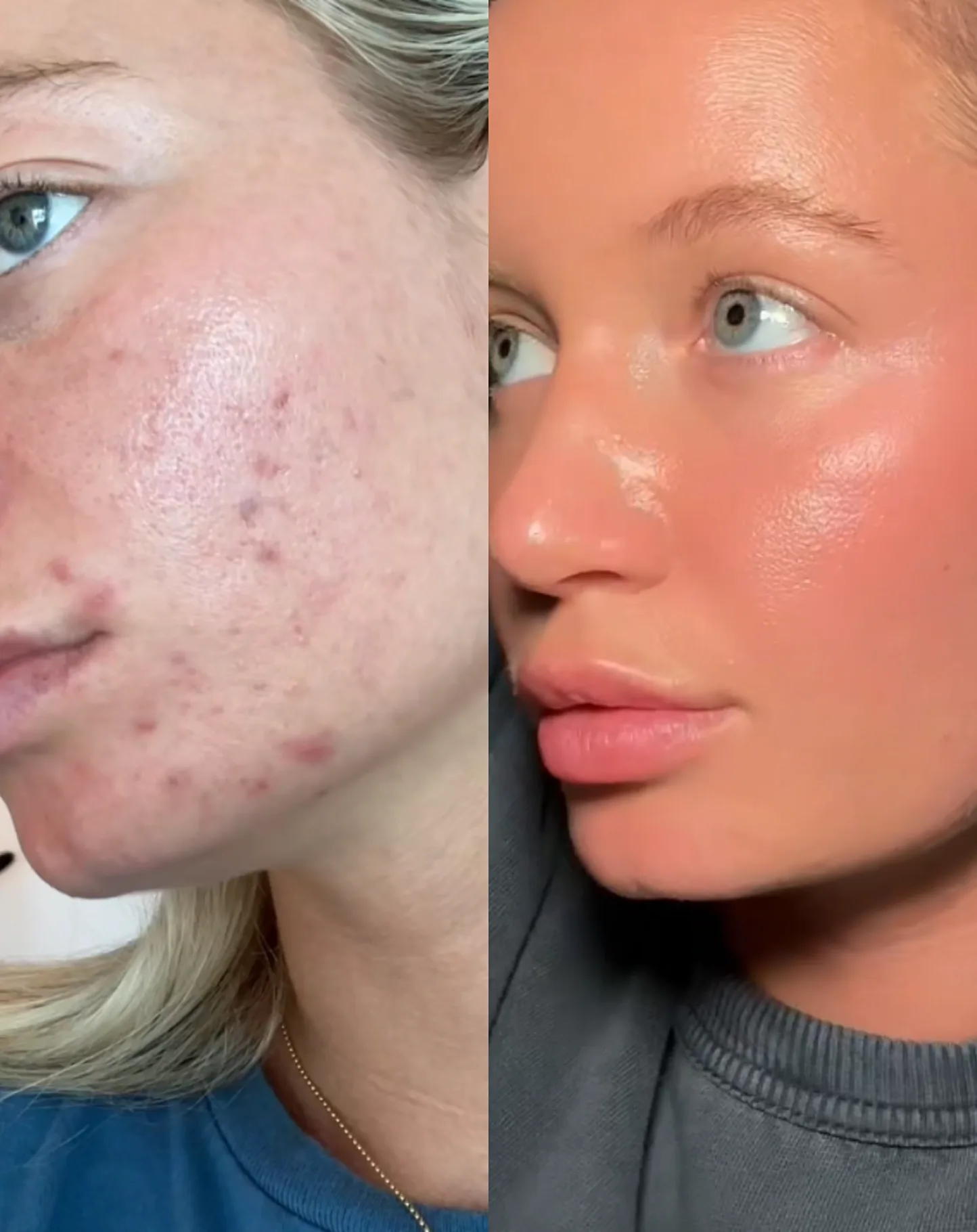Side-by-side of a face with acne and clear skin.