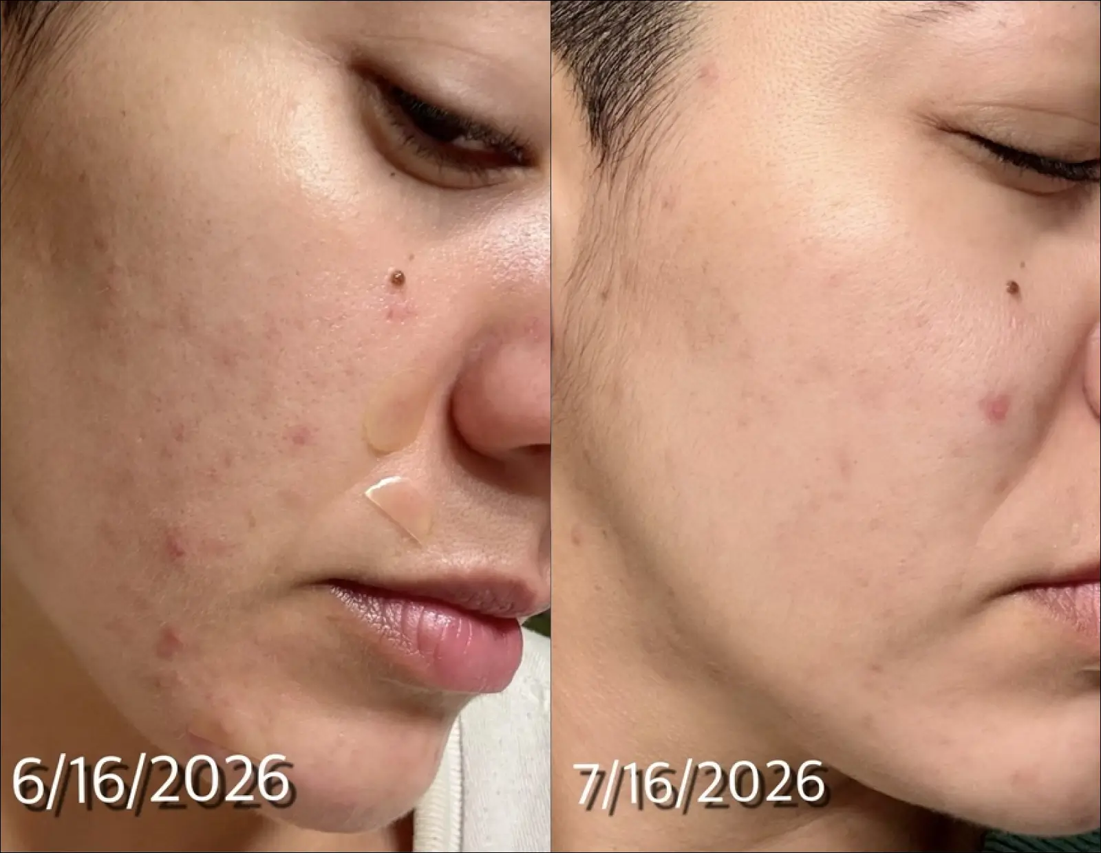 A before-and-after comparison showing a person's cheek with reduced acne and blemishes over one month.