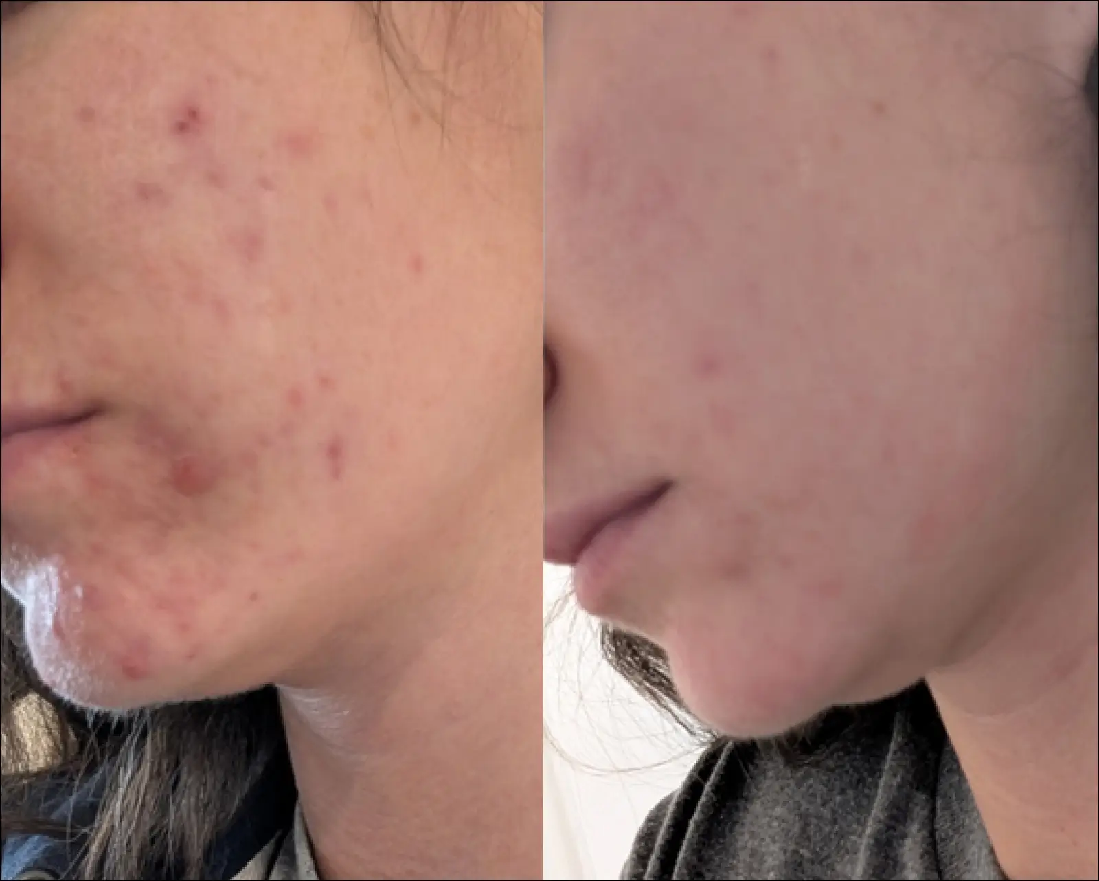 A split-screen before and after image showing the reduction of acne on a person's cheek and chin.