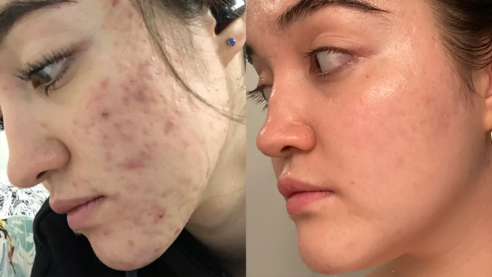 Before and after photos of a woman's face, showing a significant reduction in acne and clearer skin.