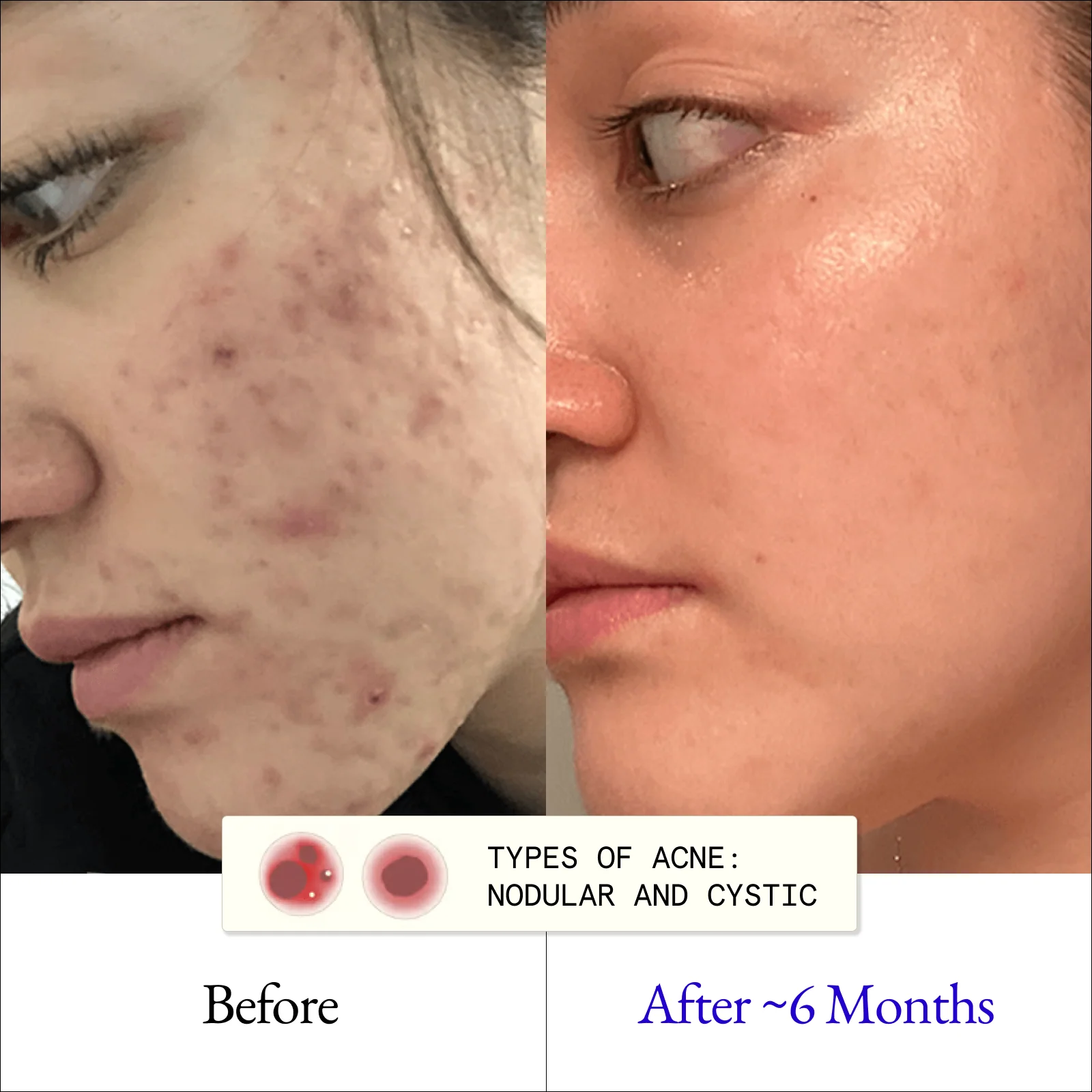 A before and after image showing significant reduction of severe acne on a person's cheek over six months.