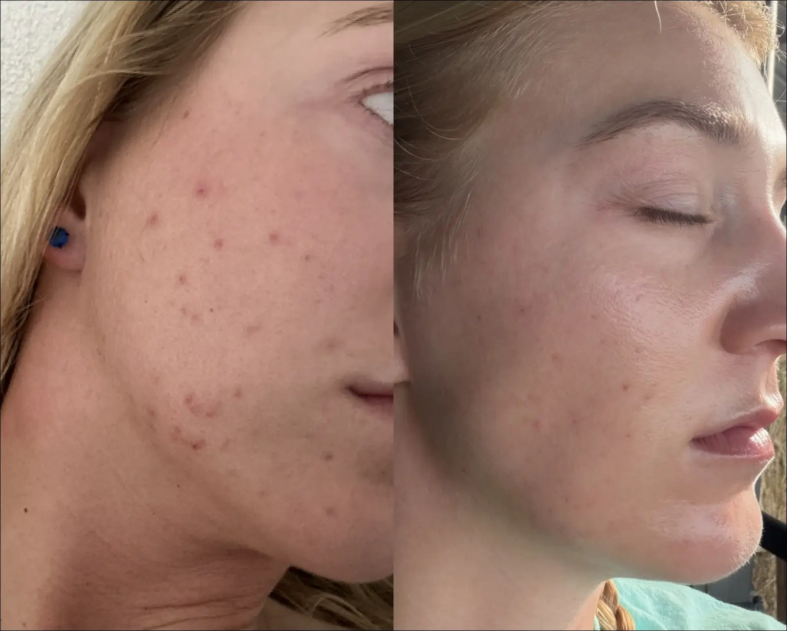 A before and after comparison of a woman's face showing a significant reduction in acne.