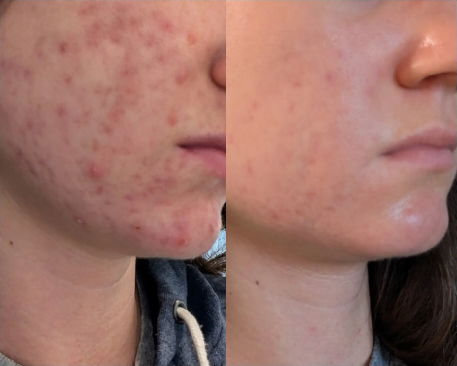 A side-by-side comparison showing a person's skin with acne on the left and clearer skin on the right.