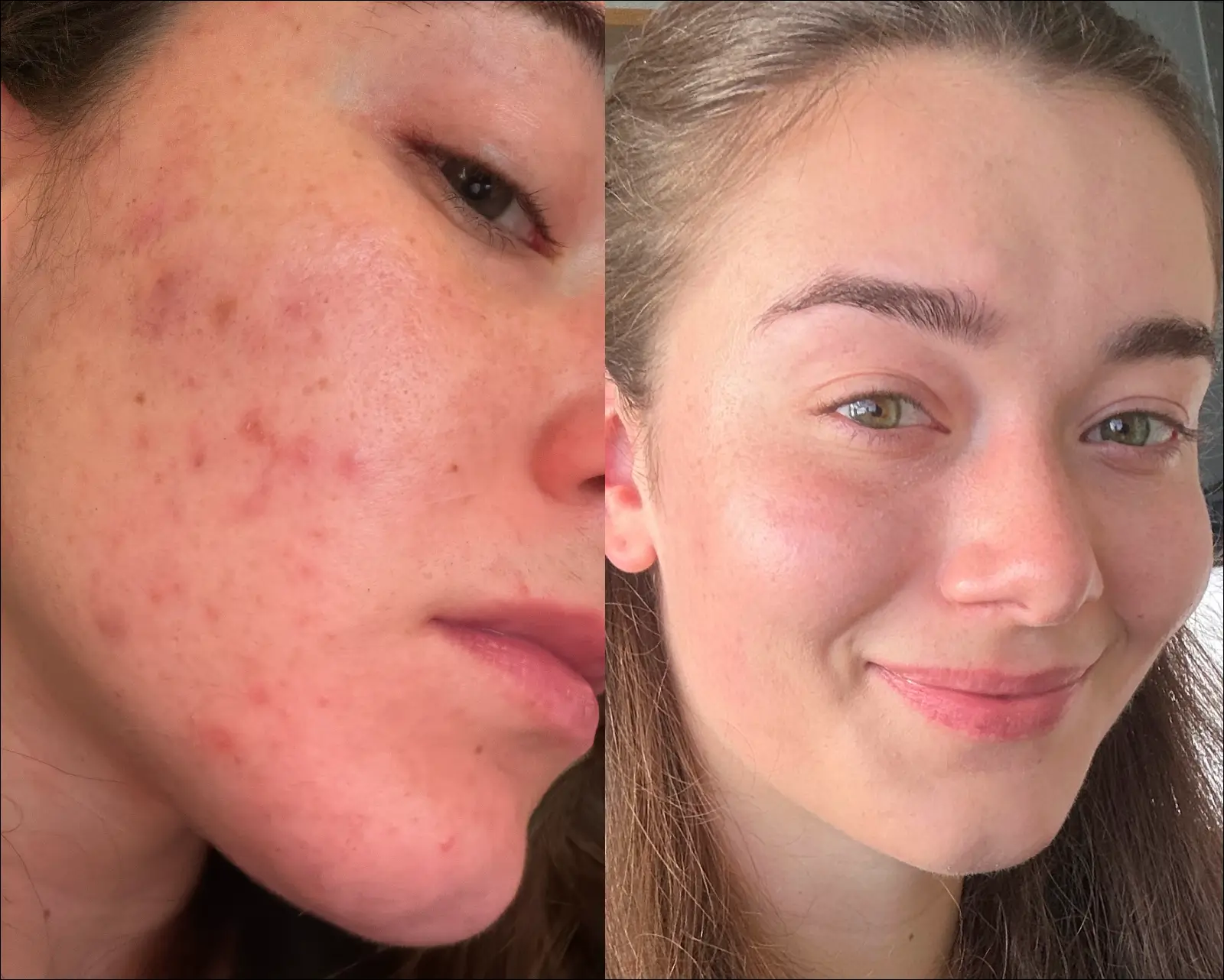 A before-and-after image showing a woman's skin improvement from acne-prone to clear and smiling.
