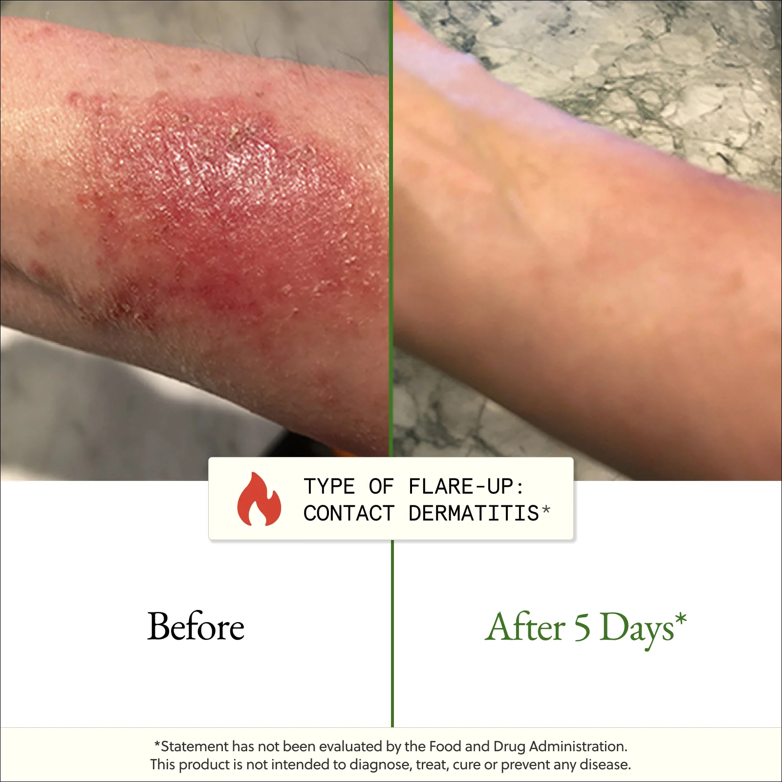 The Flare-Up Relief Protocol