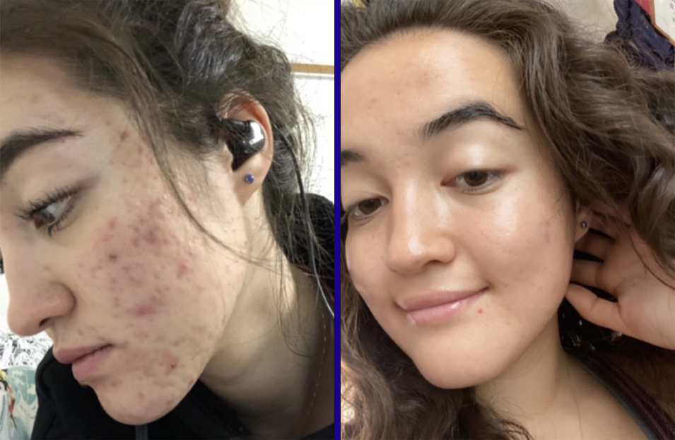 A before-and-after photo of a woman's face, showing a significant reduction in acne.