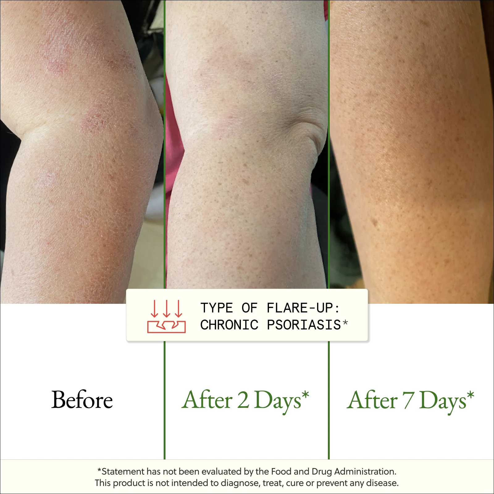 The Flare-Up Relief Protocol