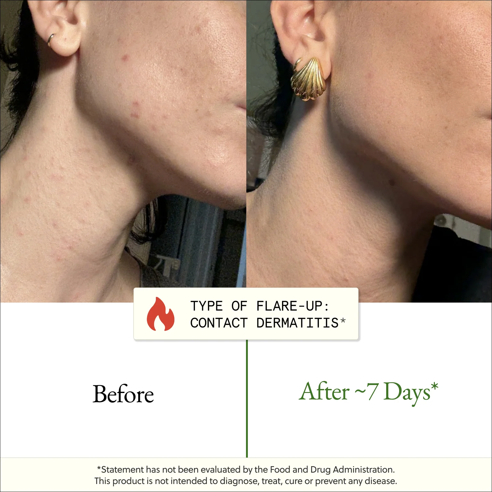The Flare-Up Relief Protocol