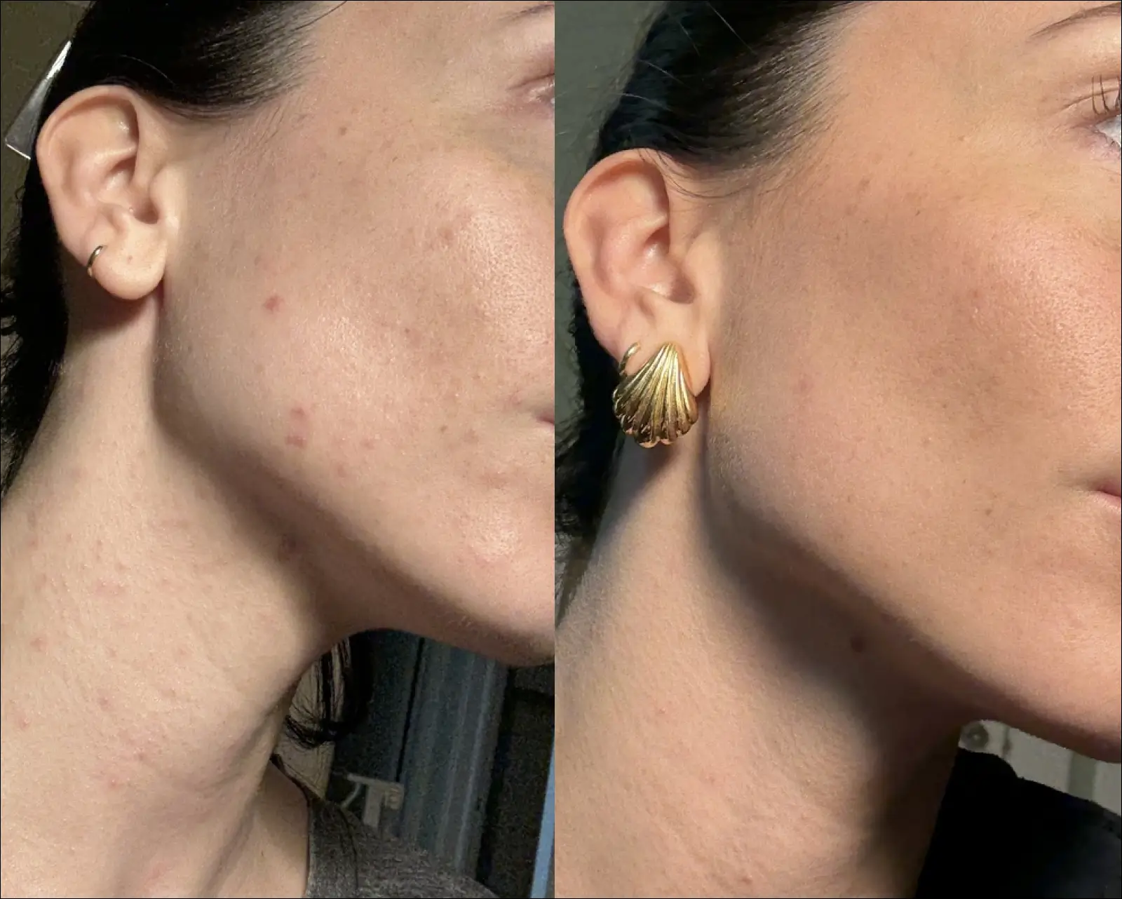 A before-and-after comparison of a woman's skin, showing a reduction in acne on her cheek and neck.