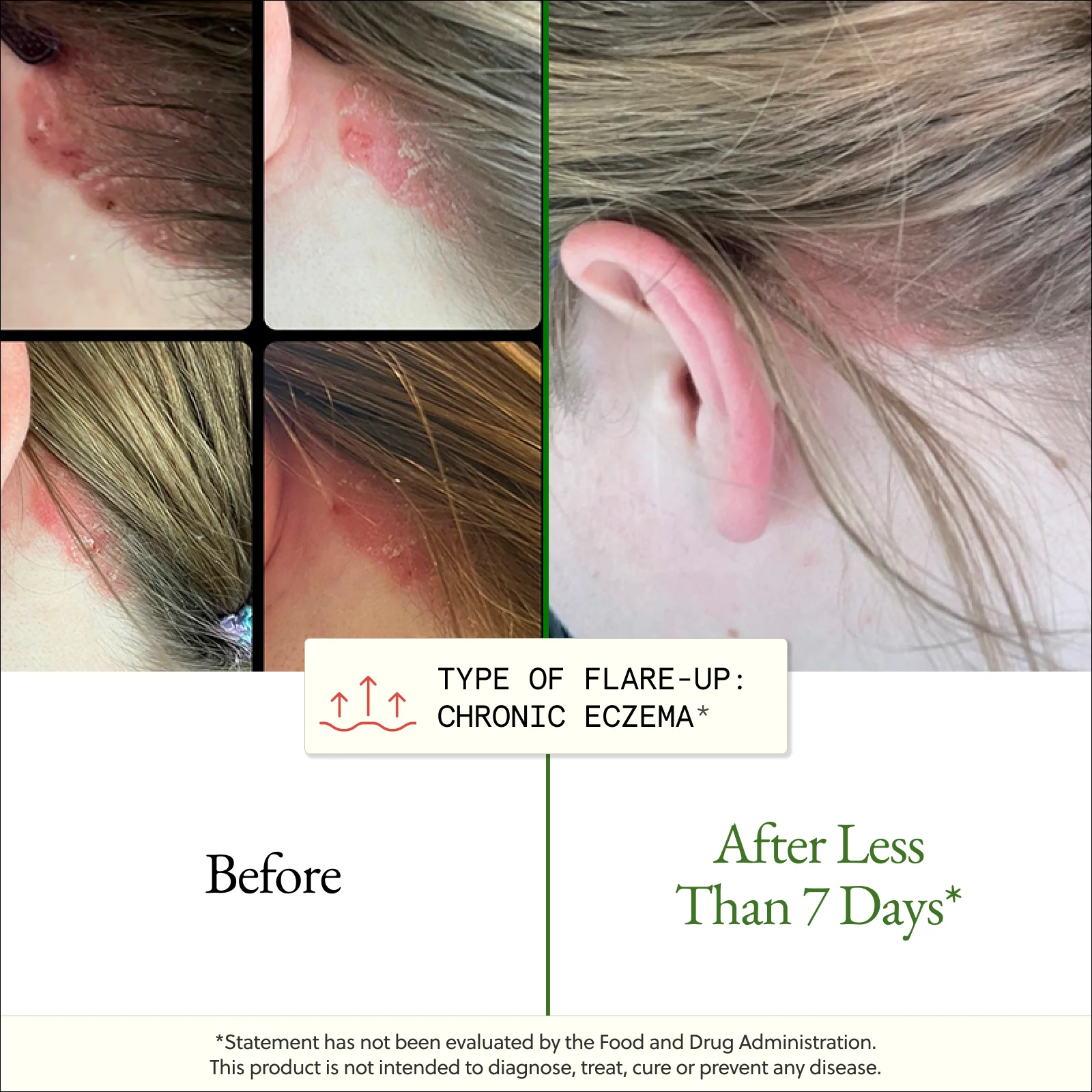 The Flare-Up Relief Protocol