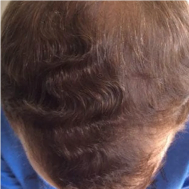 Close-up of a person's scalp with thinning hair.