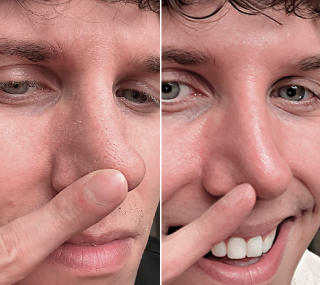 A before and after close-up of a man's nose, showing an improvement in skin texture and pores.