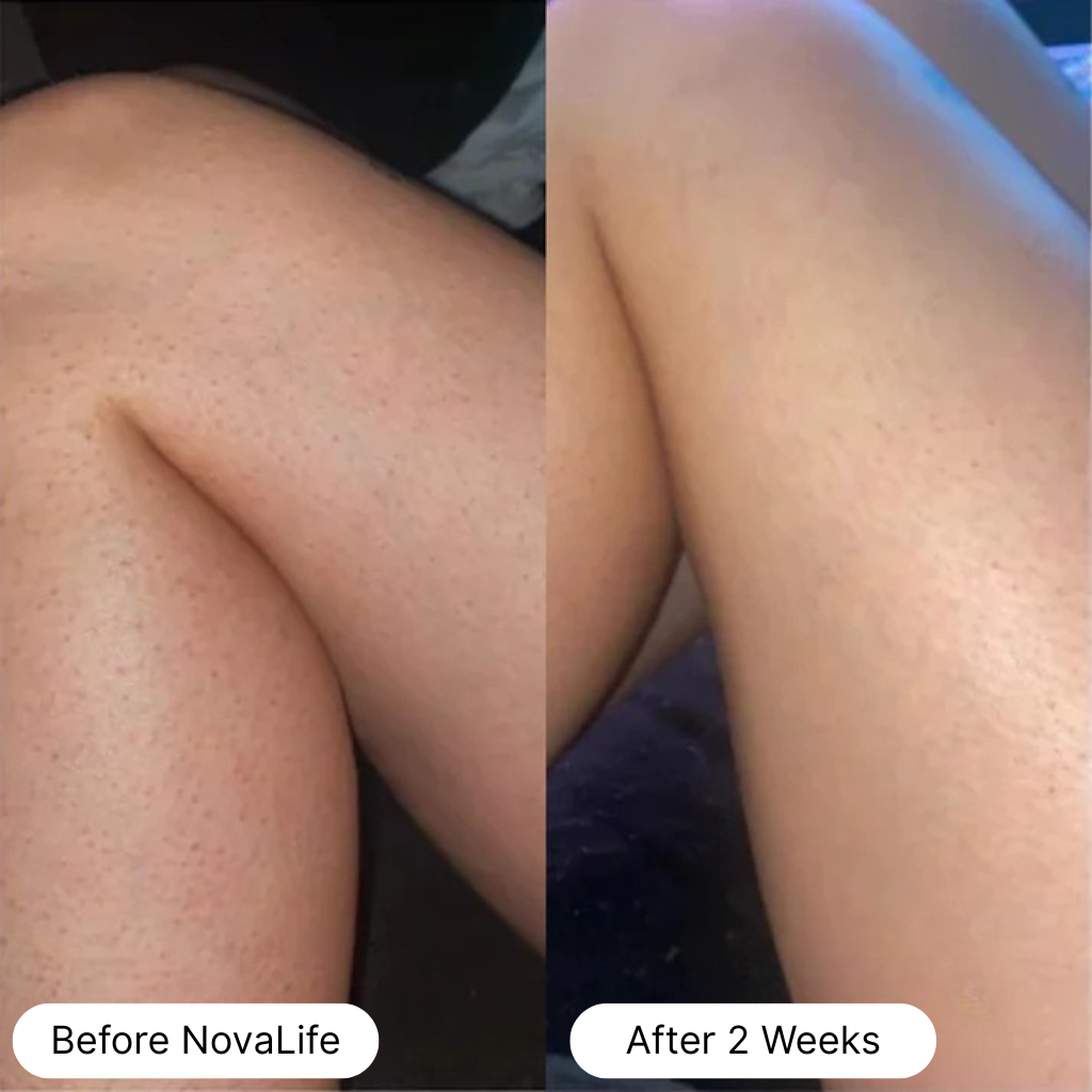 Two side-by-side images comparing skin texture labeled 'Before NovaLife' and 'After 2 Weeks'.