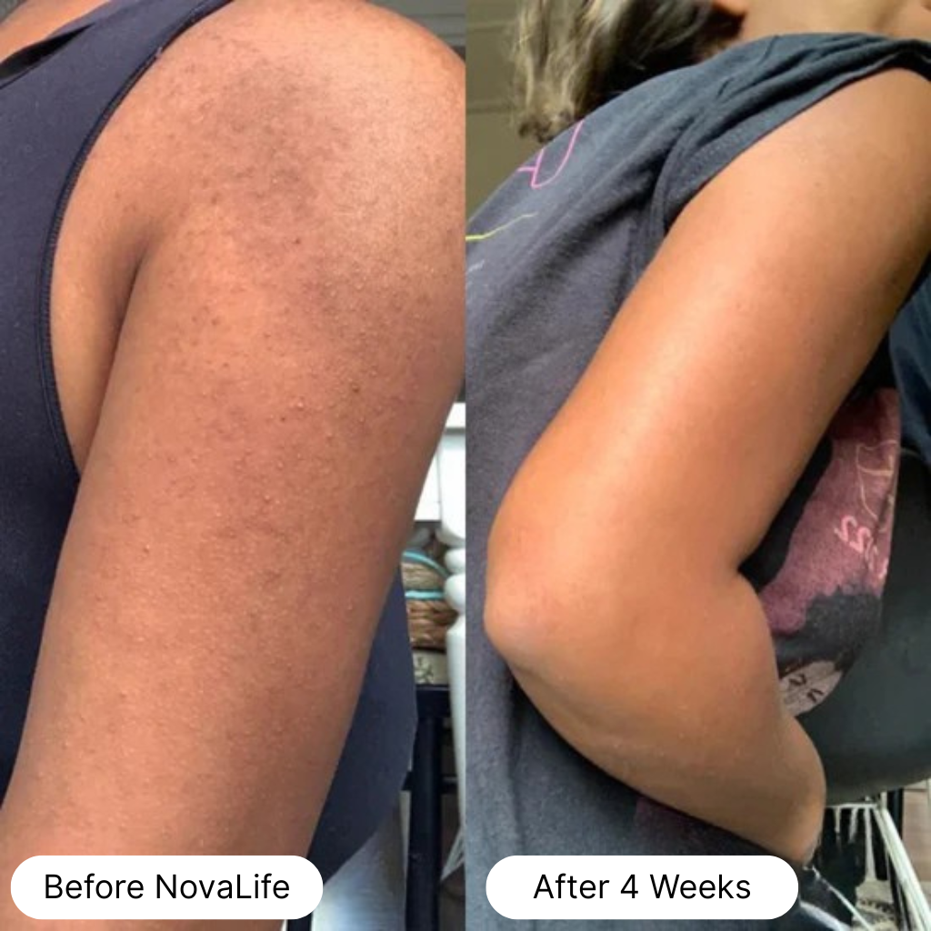 Side-by-side comparison of an arm before and after four weeks of treatment.