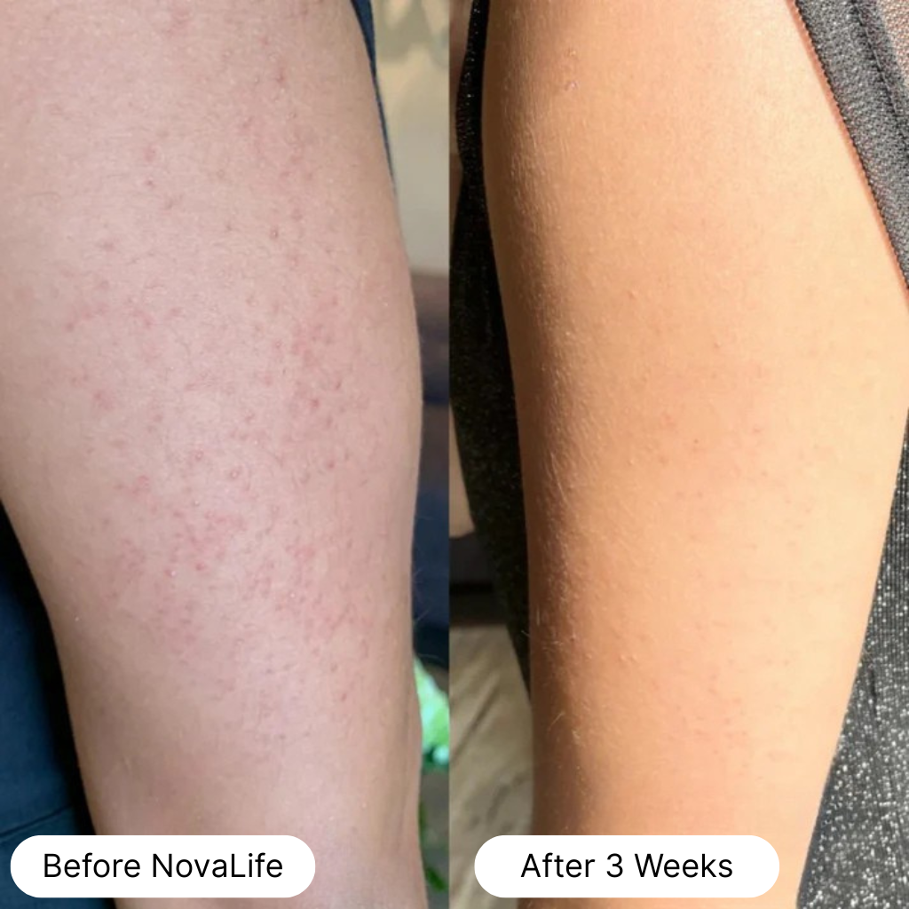 Before and after comparison of skin condition on an arm over three weeks.