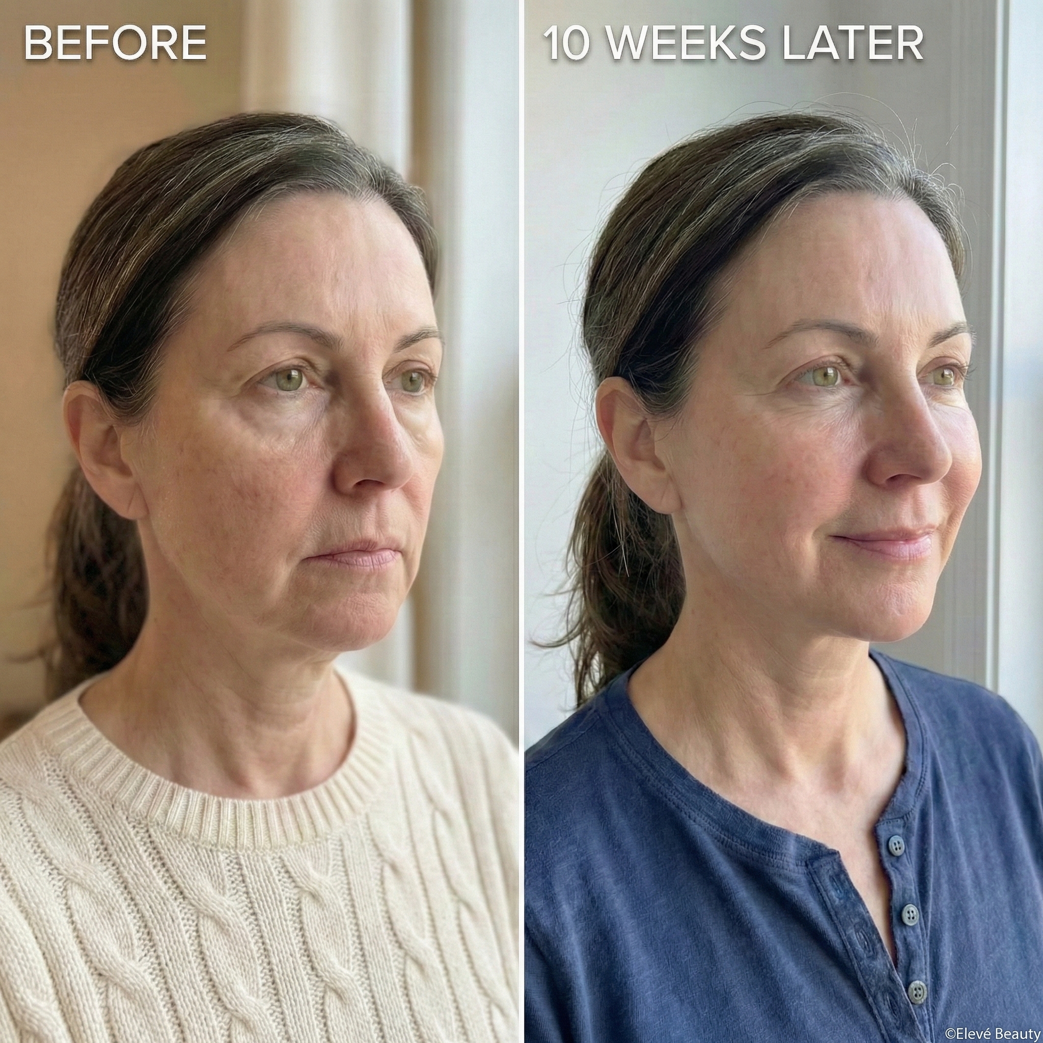 A side-by-side before and after comparison of a woman's face, taken 10 weeks apart.