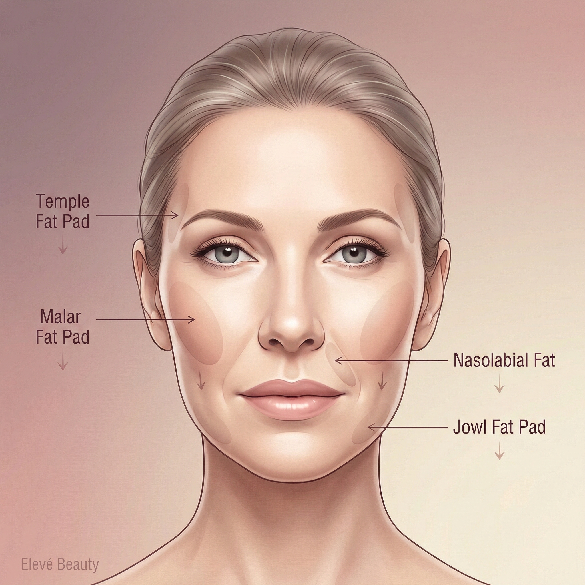 An anatomical illustration of a woman's face, labeling the temple, malar, nasolabial, and jowl fat pads.