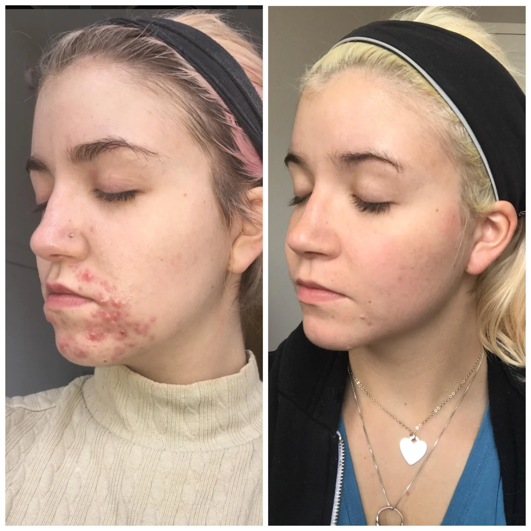 A before and after comparison of a woman's facial acne, showing significant improvement in the second photo.