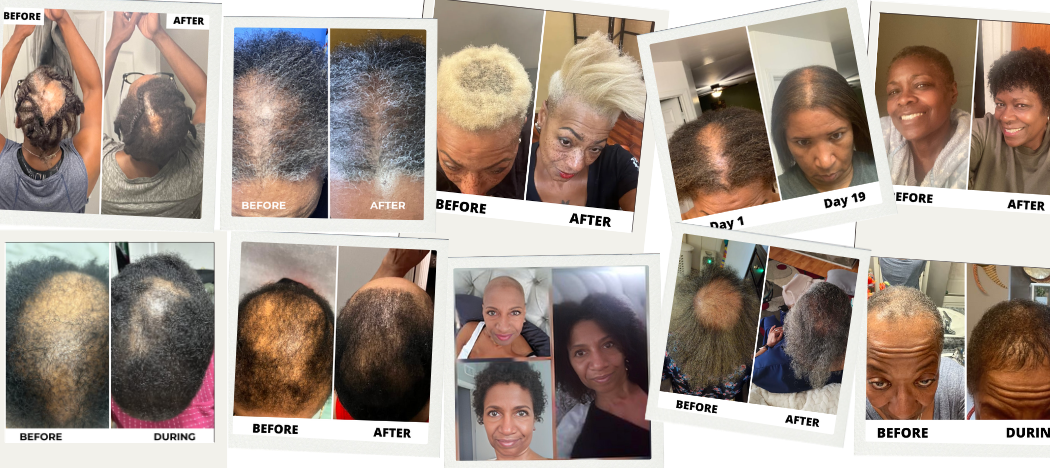 A collage of before-and-after photos showing hair regrowth results for several women.