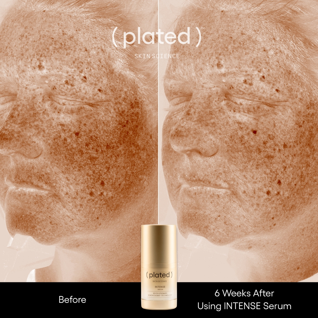 A before and after image showing the reduction of dark spots on a person's face after using serum.