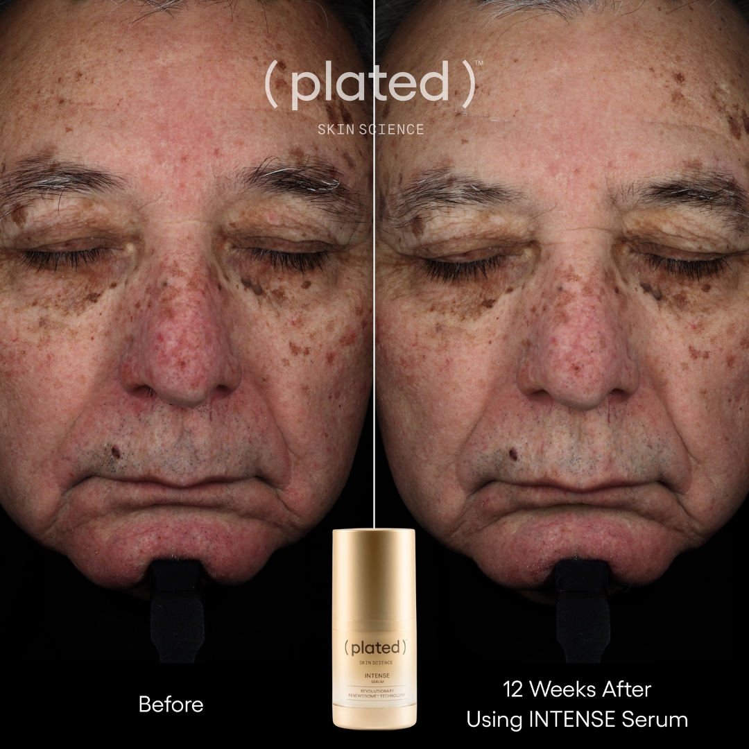 A before-and-after comparison of a man's face showing a reduction in dark spots after using a serum.