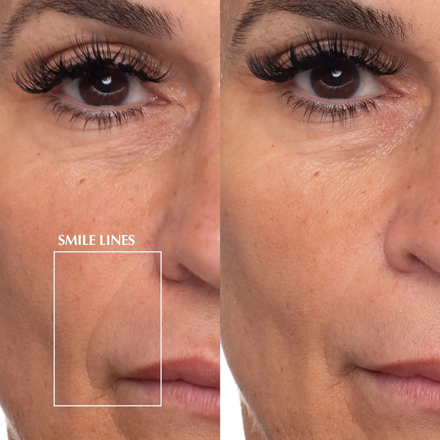 A before and after close-up image showing the reduction of smile lines on a woman's face.