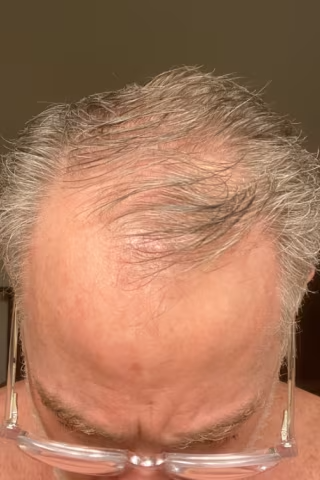 Close-up of a person's head with thinning gray hair.