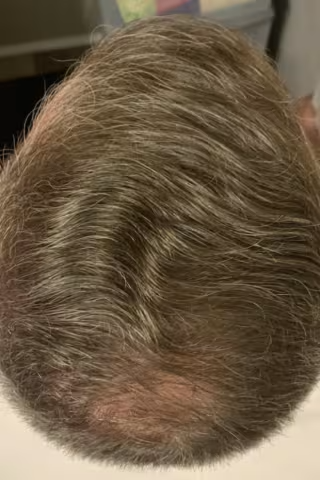 Top view of a person's head with thinning hair.