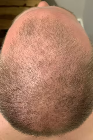Close-up of a person's bald head with short hair around the sides.