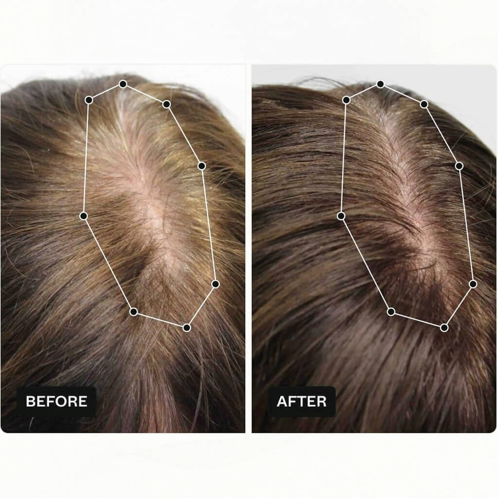 Before and after comparison of hair density on a scalp.