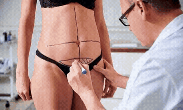 Person drawing surgical lines on a woman's abdomen.