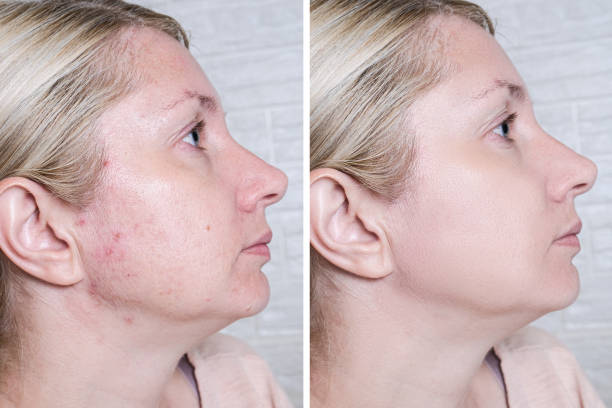 Side-by-side comparison of a woman's face before and after skin treatment.