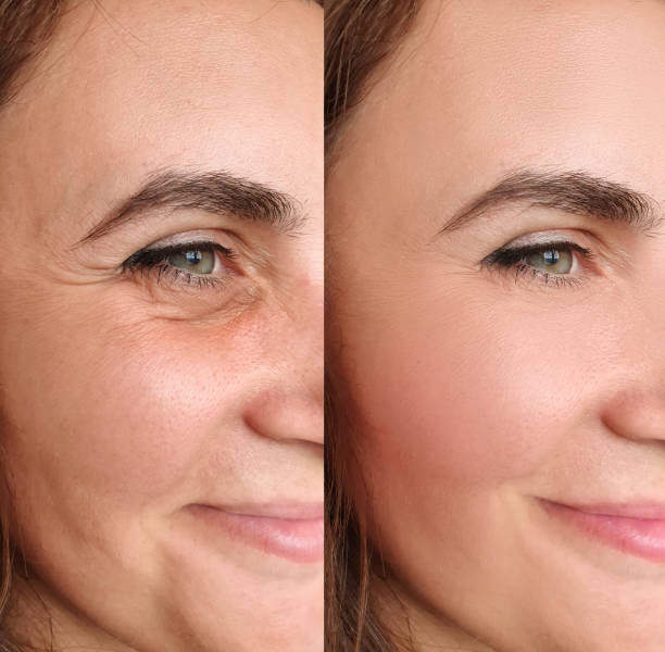 Side-by-side comparison of a woman's face before and after skin treatment.