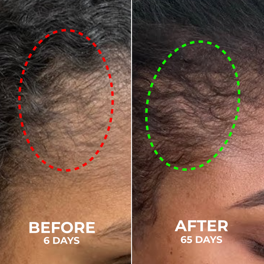 Side-by-side hair growth comparison over 65 days, with red and green dotted circles.