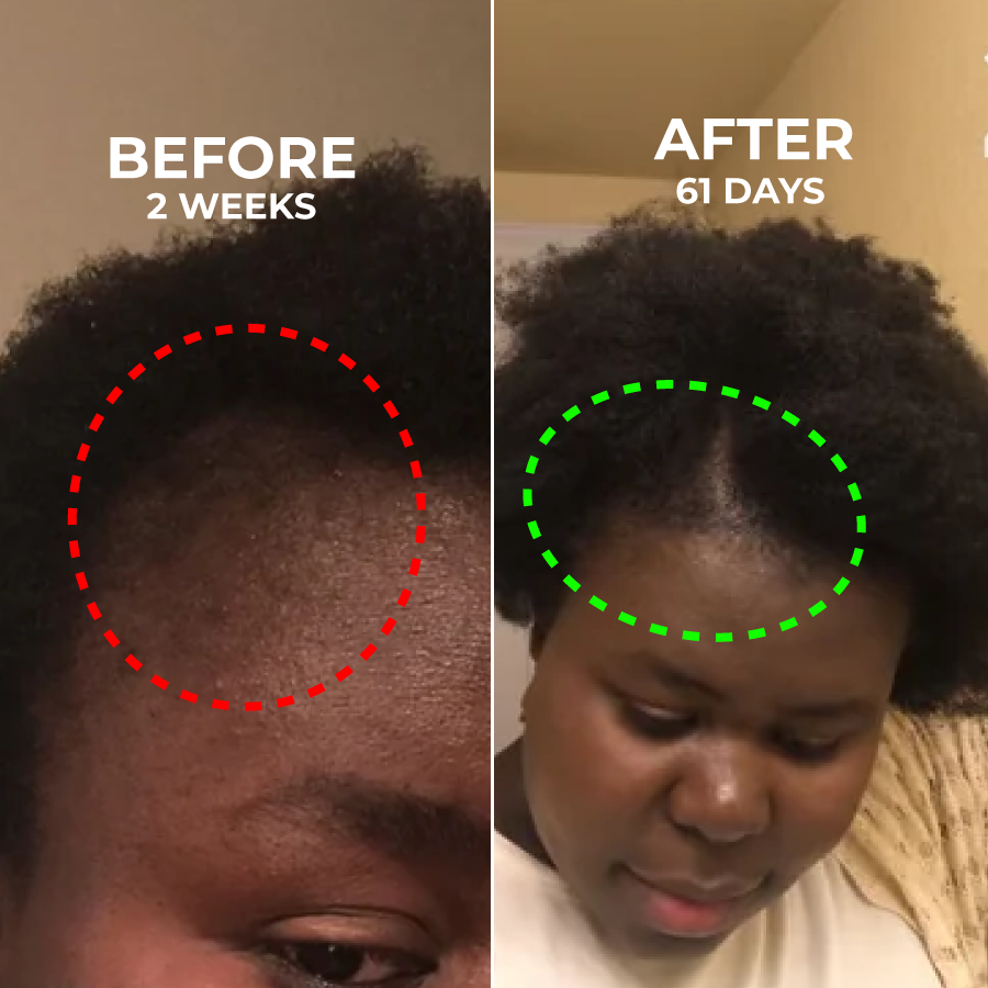 Side-by-side hair growth comparison over two weeks and 61 days.