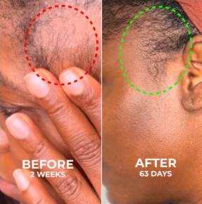 Side-by-side comparison of hair growth over time with 'Before' and 'After' labels.