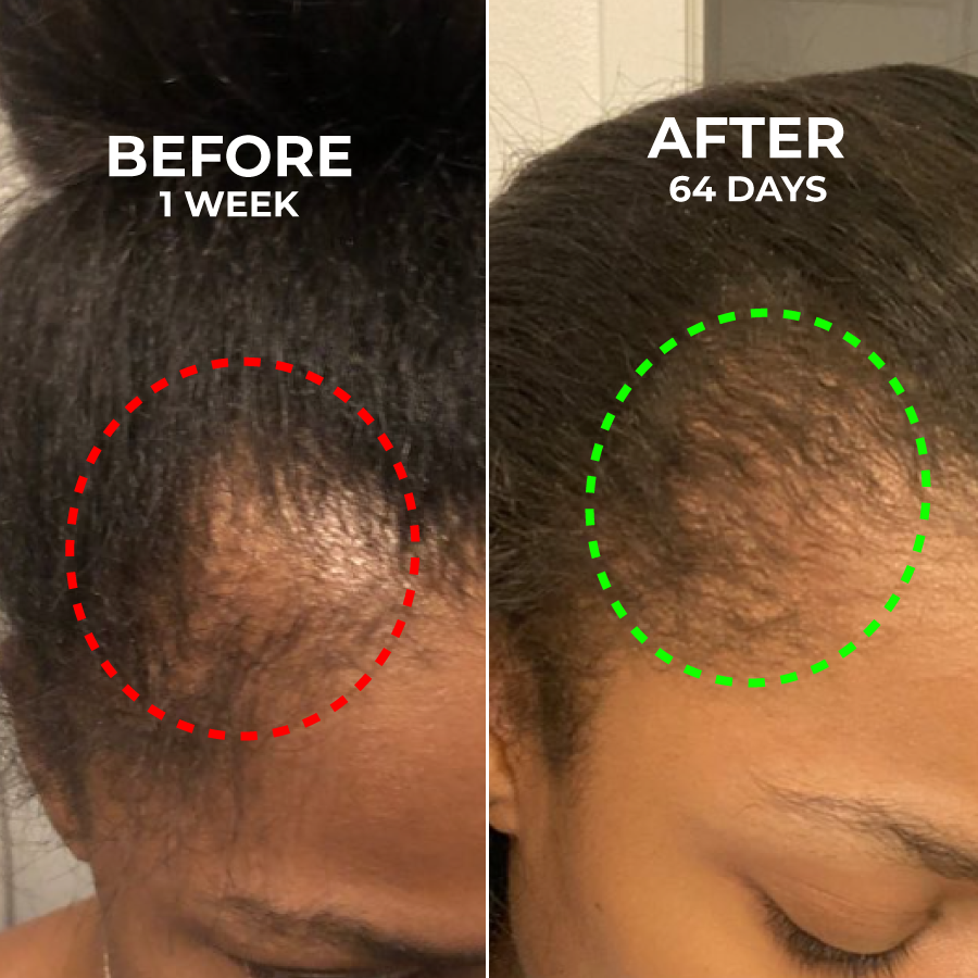 Comparison of hair growth before and after 64 days, highlighted with circles.