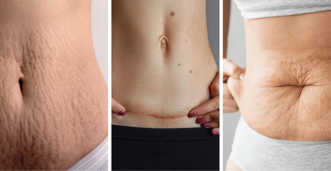 How you support your skin during this 12-month rebuilding process will affect three things: