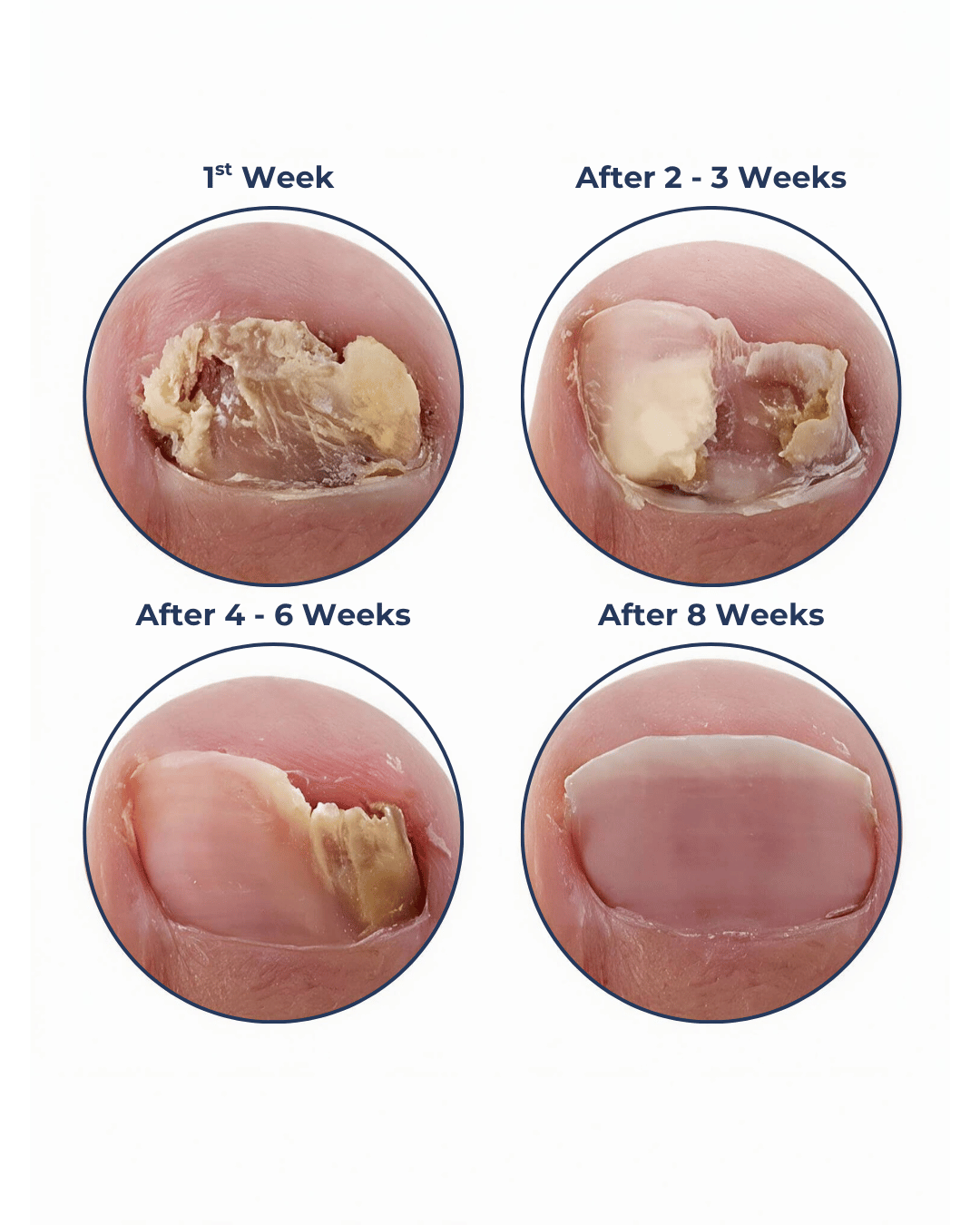 Four images showing a damaged toenail healing over an eight-week period.