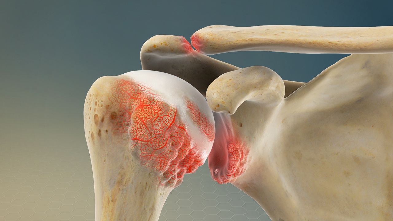 Illustration of a shoulder joint with red inflammation areas.