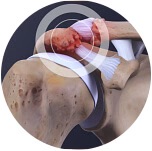 Illustration of a shoulder joint showing muscles and ligaments.