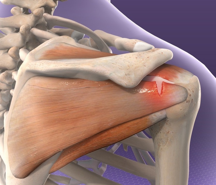 Illustration of shoulder muscles and bones with a highlighted tear.
