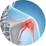 Diagram of a shoulder joint highlighted to indicate pain or inflammation.