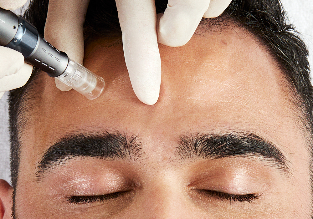 Person receiving a microneedling treatment on the forehead.