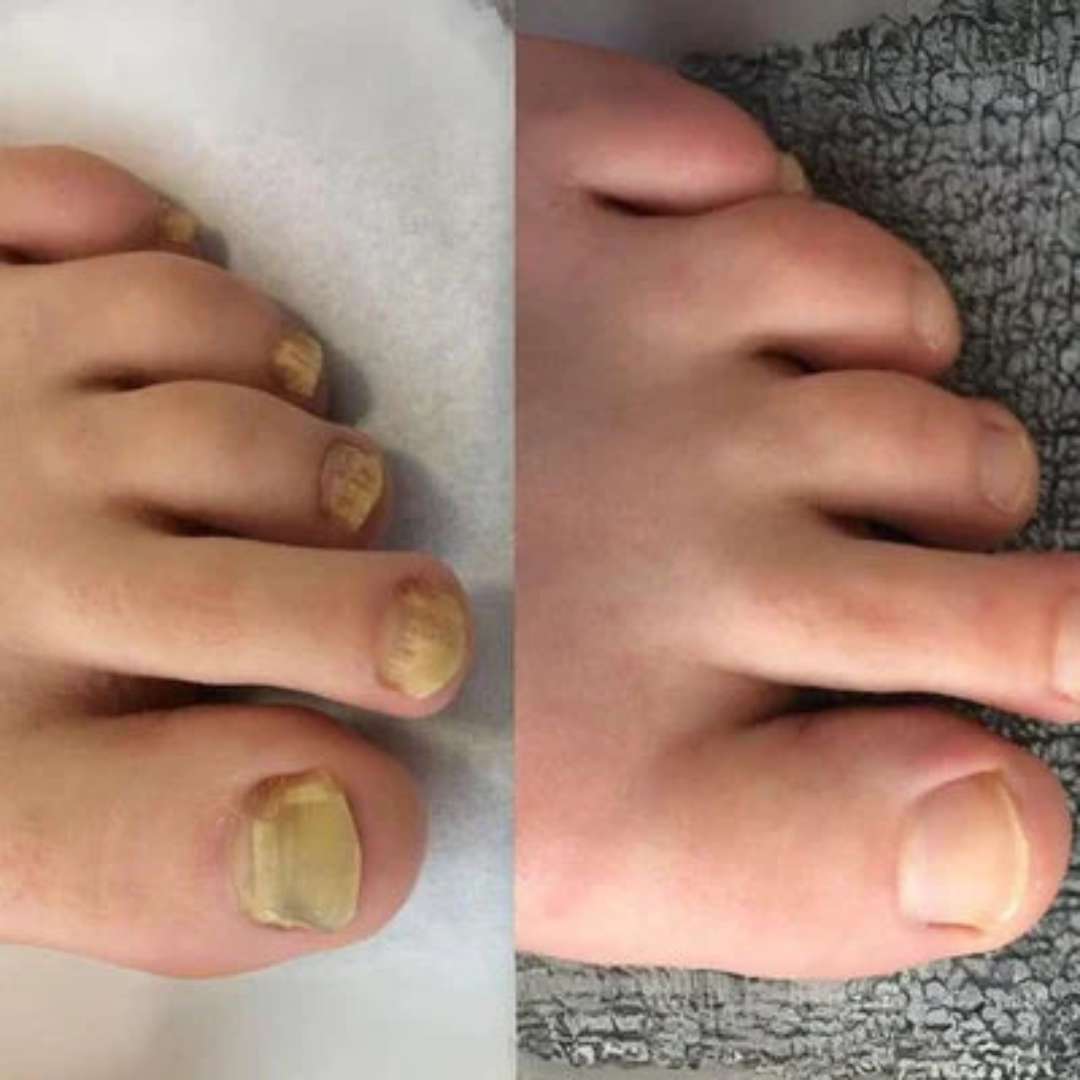 A before-and-after image of a foot, showing discolored yellow toenails on the left and healthy nails on the right.