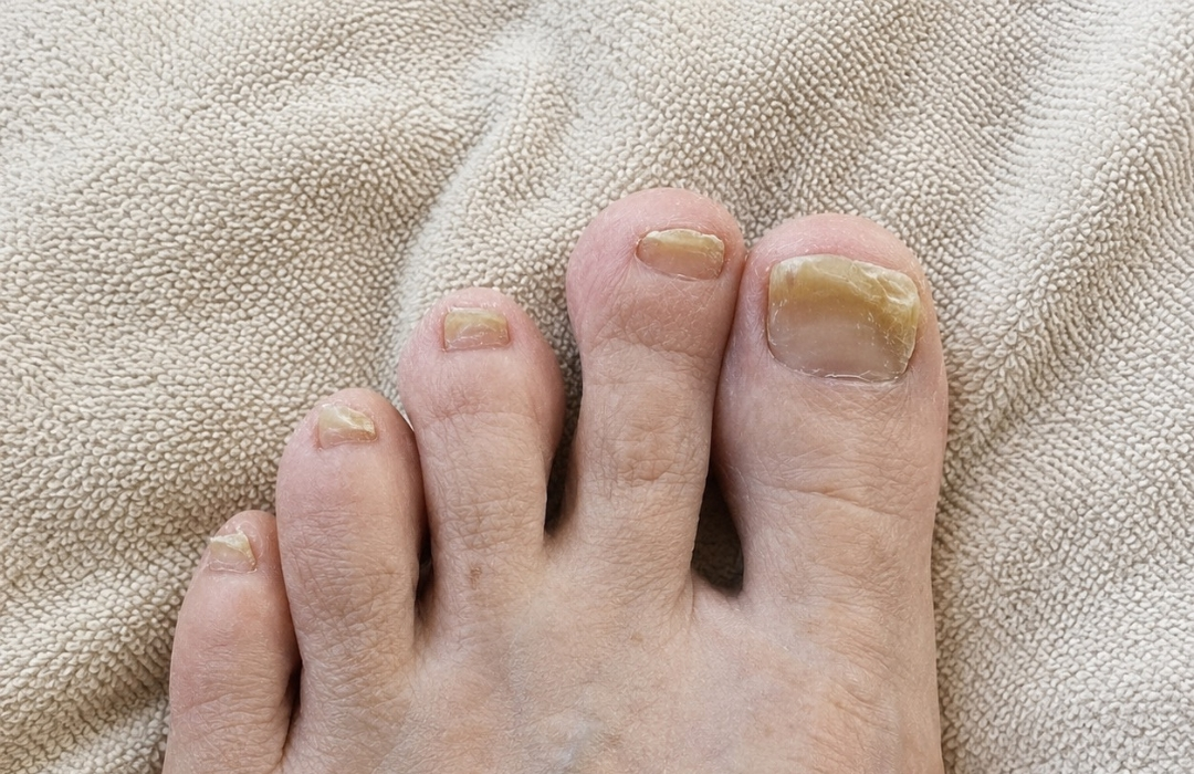 A close-up of a foot with yellow, thick, and brittle toenails on a textured towel.